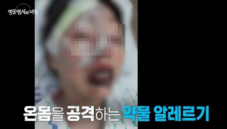 약물알레르기