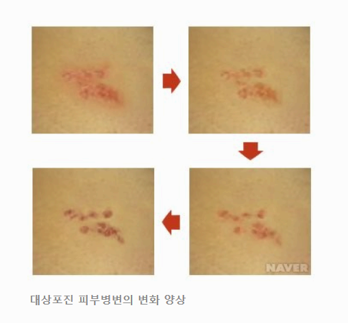 대상포진 예방 주사, 꼭 맞아야 할까? 효과·부작용·비용 총정리