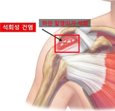 석회성 건염 치료