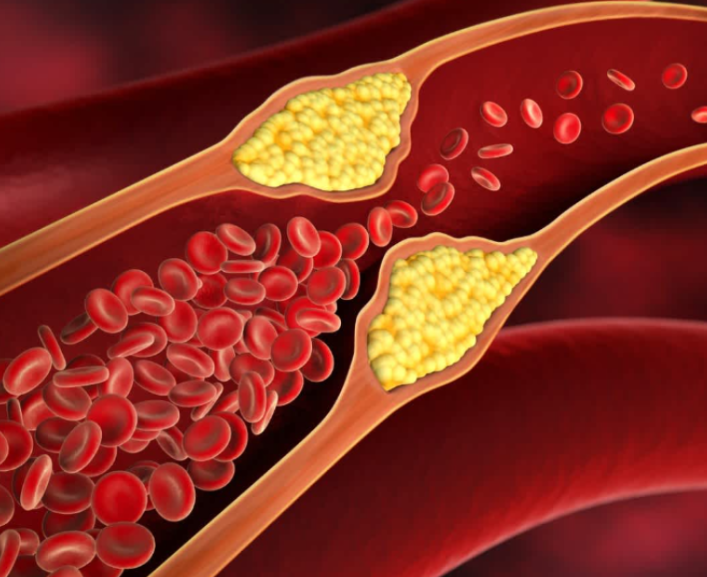 중성지방의 원인