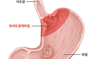 식도암이미지