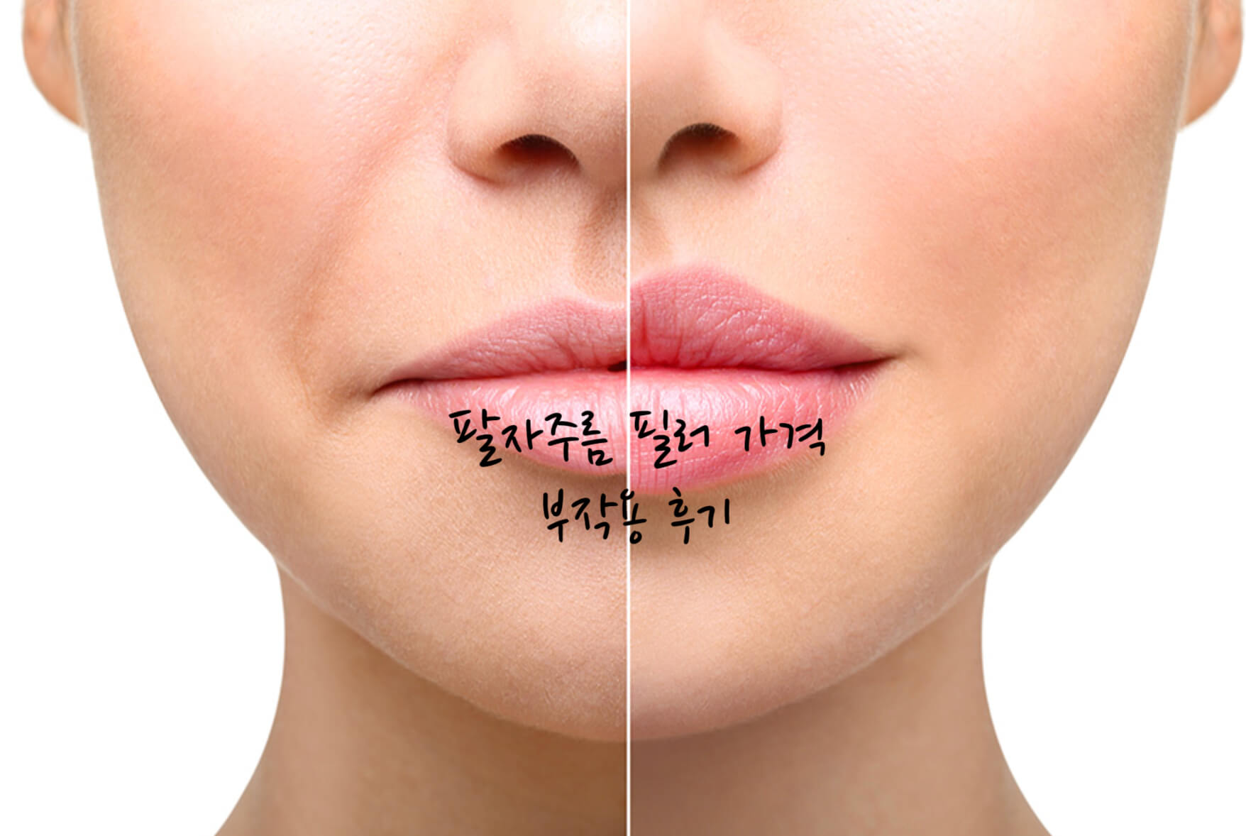 팔자주름 필러