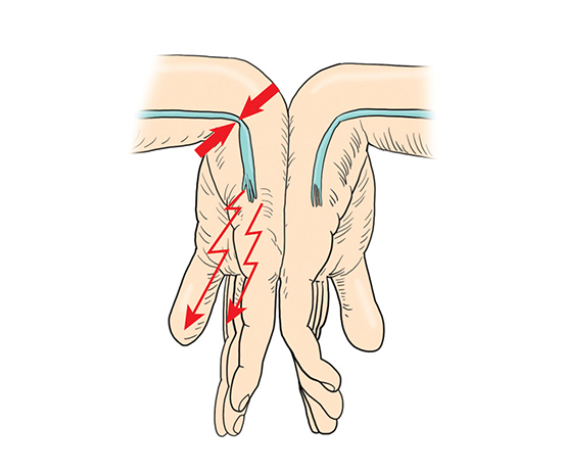 자가 손목 통증 테스트