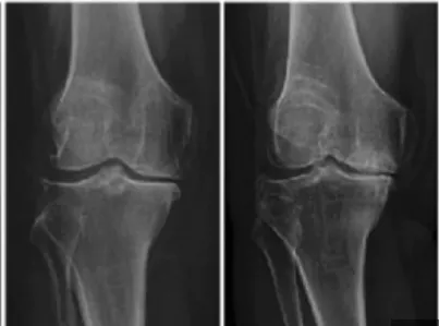 무릎-관절염에-좋은-운동-주의사항