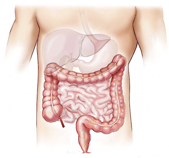 대장암초기증상-이미지
