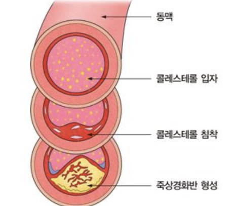 고지혈증 약의 부작용 1