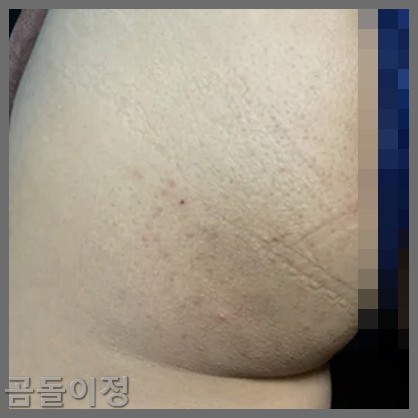 성인 엉덩이 두드러기 땀띠 뾰루지, 병원 안 가고 해결한 방법