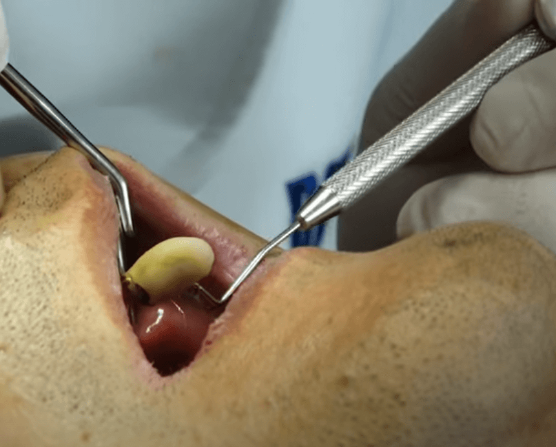 임플란트 주위염 ; 증상&amp;#44; 원인&amp;#44; 예방 및 관리방법 알아보기(재수술&amp;#44; 부작용&amp;#44; 재식립)