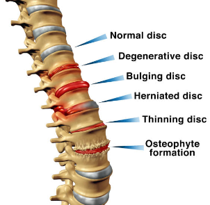 허리디스크 수술