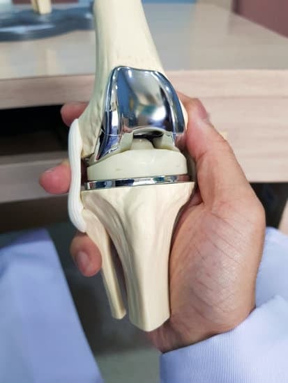 전치 인공관절 치환술 (Total Knee Replacement, TKR)
