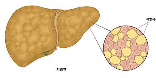 비알콜성 지방간