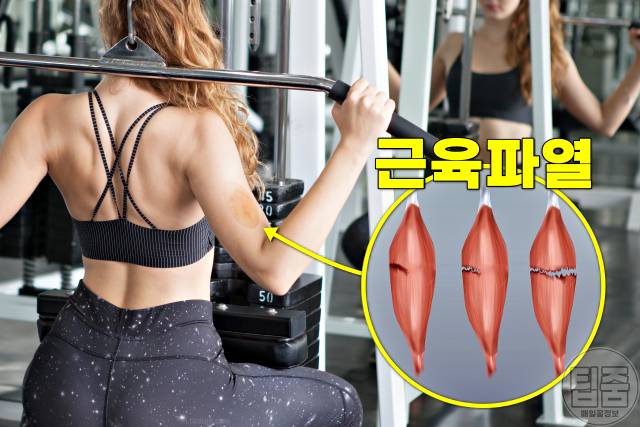 팔 다리 멍 자주 생기는 이유 멍원인 근육파열