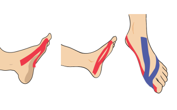 외반모지(엄지발가락 휘어짐)
