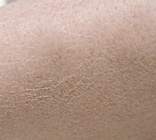 건성 피부 타입