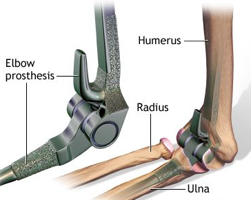 팔꿈치 인공관절