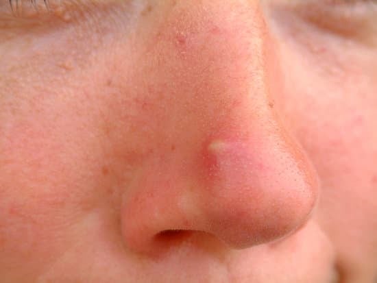 벤조일퍼옥사이드 (Benzoyl Peroxide, BPO): 여드름 치료의 기본 성분
