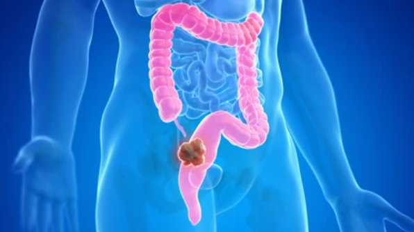 대장용종 원인/치료방법/예방방법