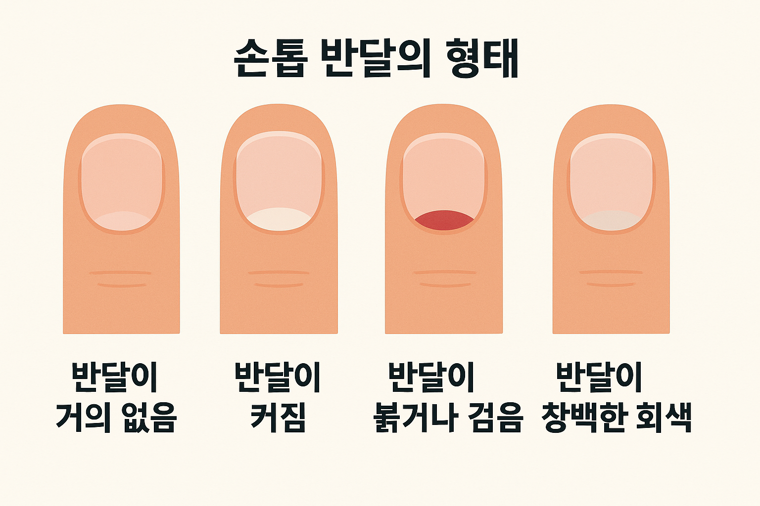 손톱 반달의 형태