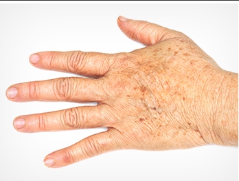 검버섯 없애는 방법