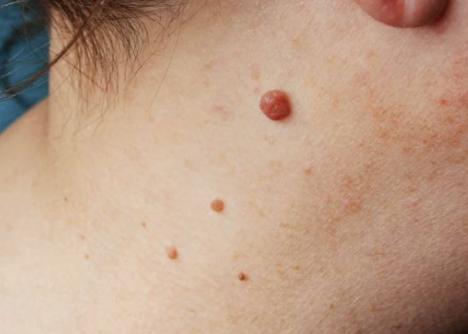 목에 있는 쥐젖