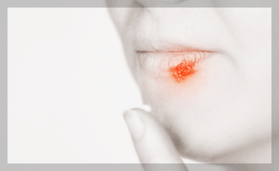 입술 물집 포진 원인, 증상, 치료, 예방 3분 제대로 총정리
