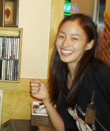 임플란트 후 교정 김태희 수지 효과