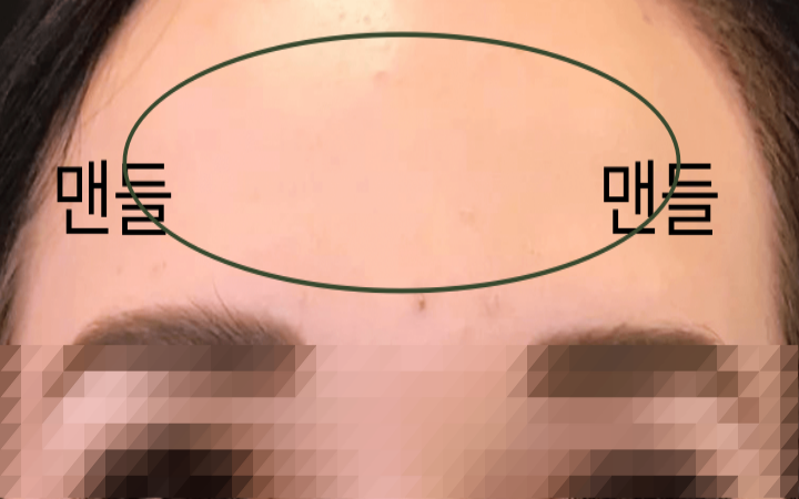 이마-보톡스-시술-효과로-이마가-맨들해진-모습