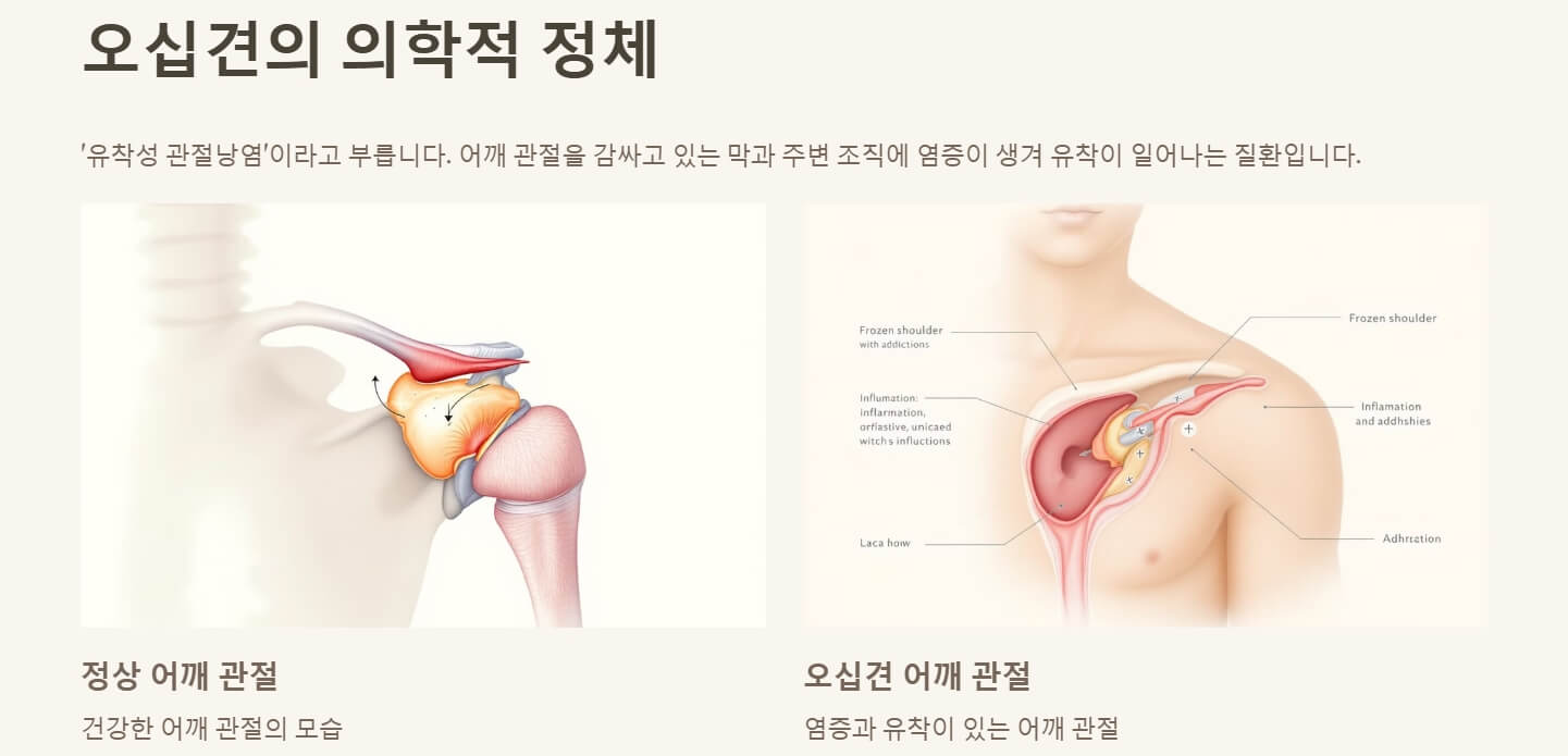 오십견 증상 치료방법