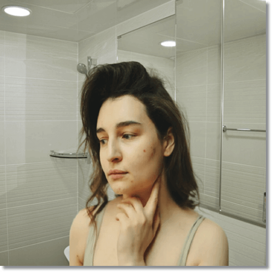 피부건강에 좋은 춧고추, 피부염이 생긴 여성 사진