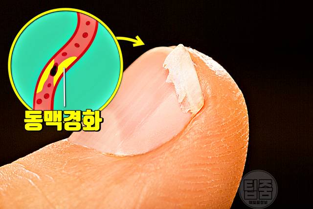 손톱 갈라짐 이유 손톱부러짐 혈행장애