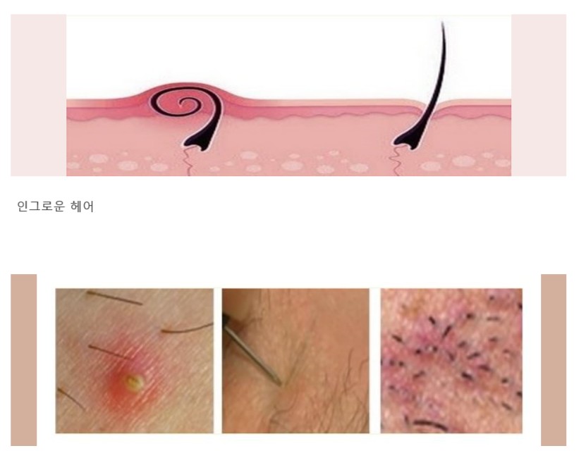 인그로운 헤어 피부 상태