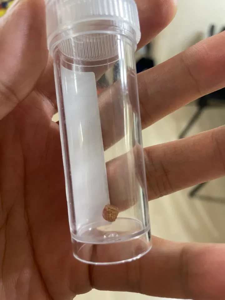 수술후 나온 돌의 이미지