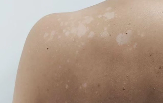 어루러기 증상 3가지