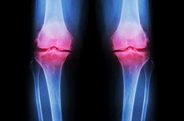 무릎에 물 찼을때 대처법과 원인들, 무릎이 부어서 통증이 느껴지지만 걷는데 지장을 주지 않거나 심한 통증을 유발하지 않는 경우에는 며칠 쉬면 나을 것이라고 생각하여 건너뛰는 경우가 많습니다. 무릎에 물이 차는 증상이 아닌지 의심해 보시고 빠른 시일 내에 병원에 가야 합니다. 그럼 그 원인들은 무엇인지 참고하시기 바랍니다.