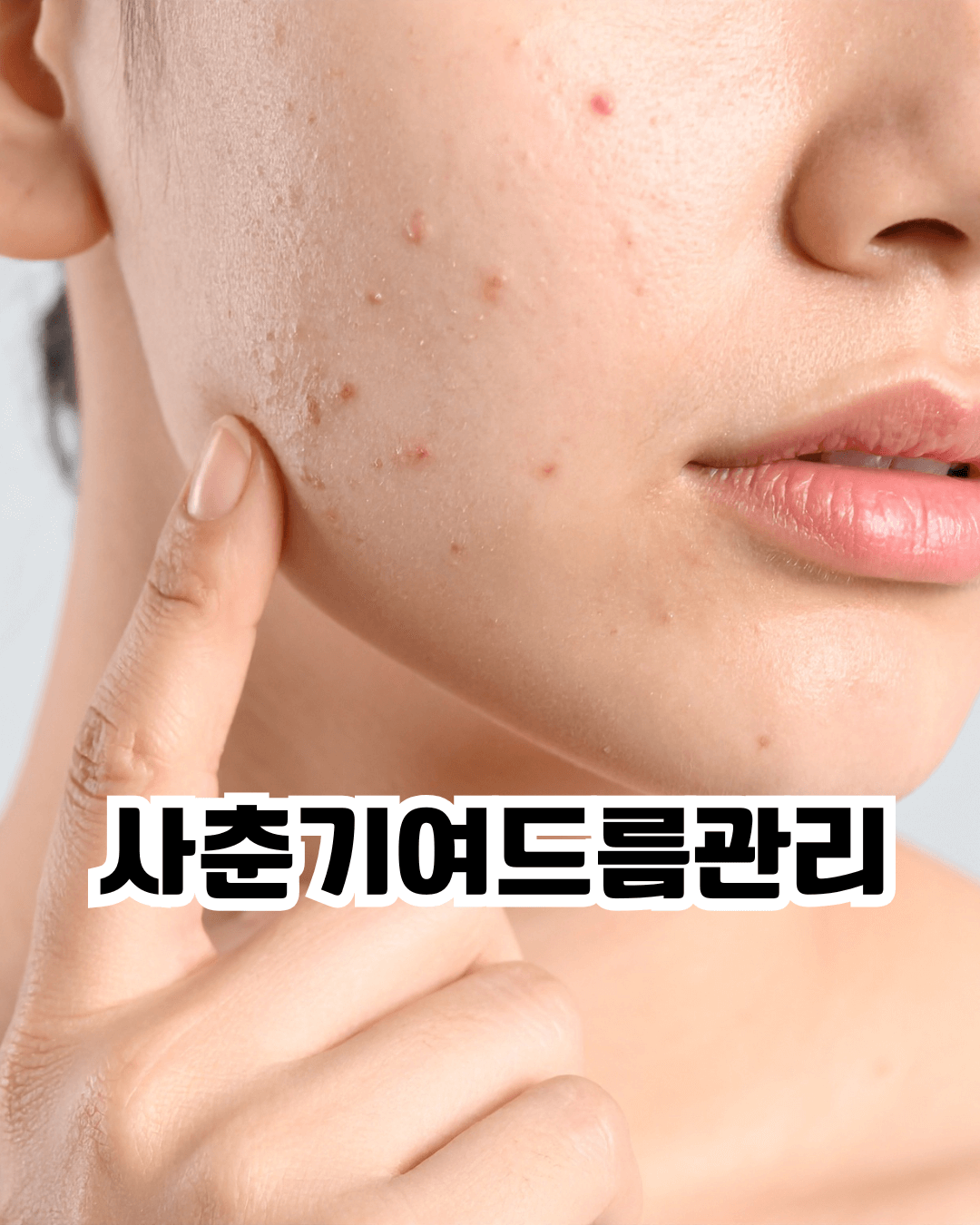 사춘기 여드름 발생 원인과 청소년 피부 관리 방법을 설명하는 스킨케어 정보 이미지로 올바른 세안법과 생활 습관 개선 팁을 담은 피부 관리 가이드