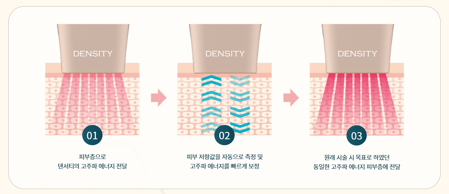 덴서티-써마지-고주파-이영애-리프팅-효과-통증-가격