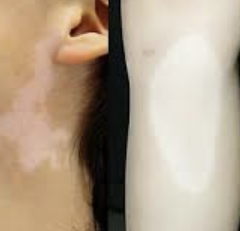 백반증 초기증상 18