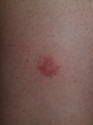 에스로반연고 바르는 부위