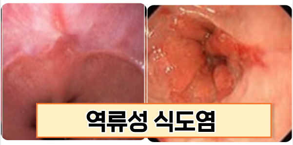 역류성식도염