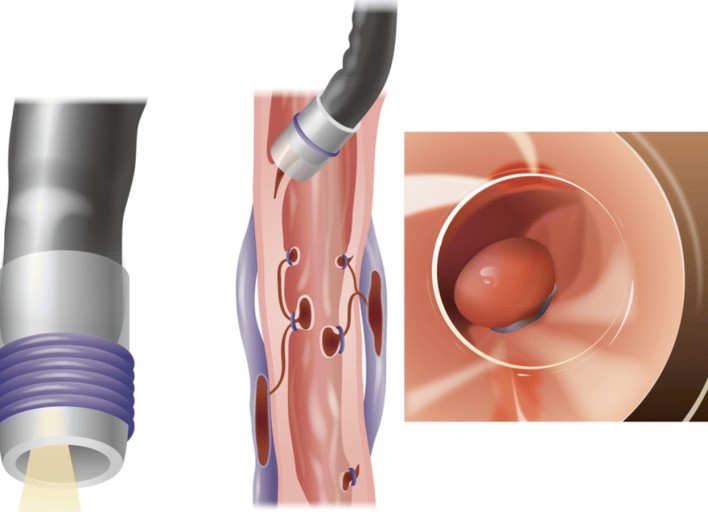 식도정맥류 결찰술