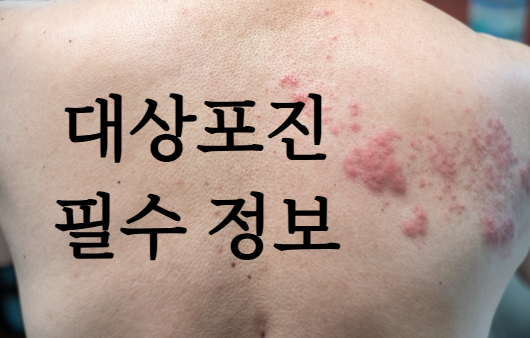 대상포진 필수정보