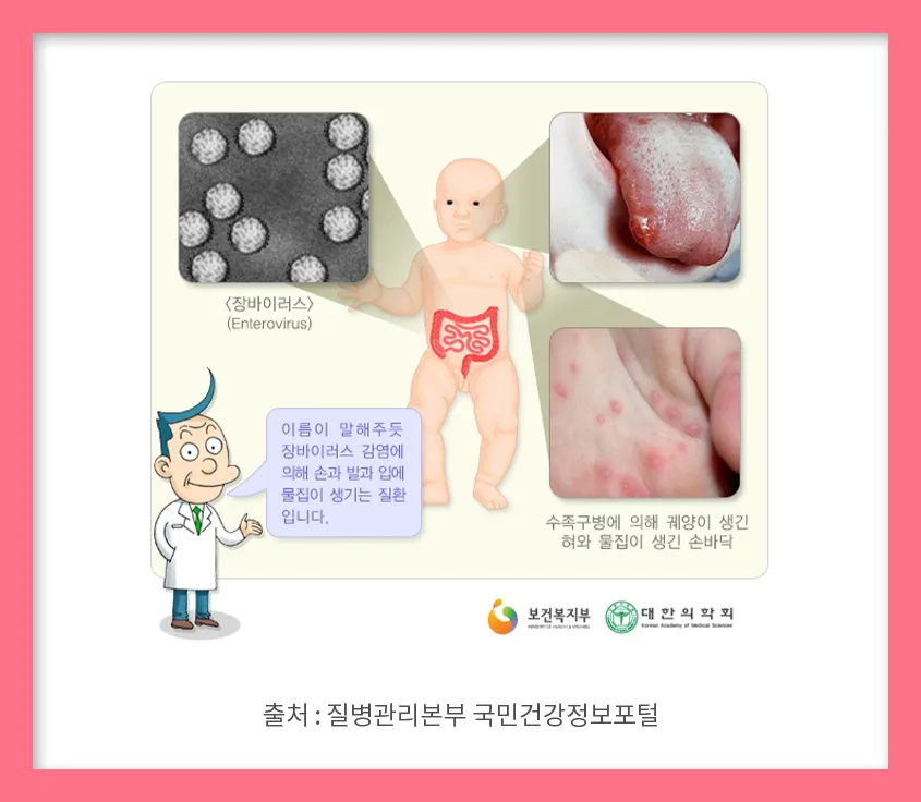 수족구병 증상과 예방 조치 방법 모음_4