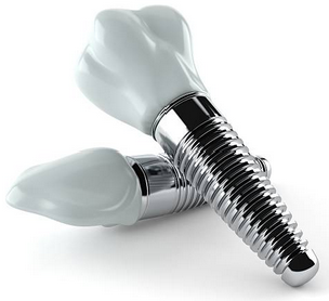 어금니 임플란트