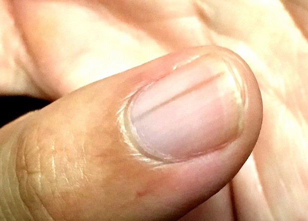 손톱