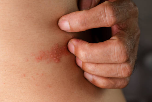 대상포진 증상, 전염, 치료방법 총정리 (2024ver)