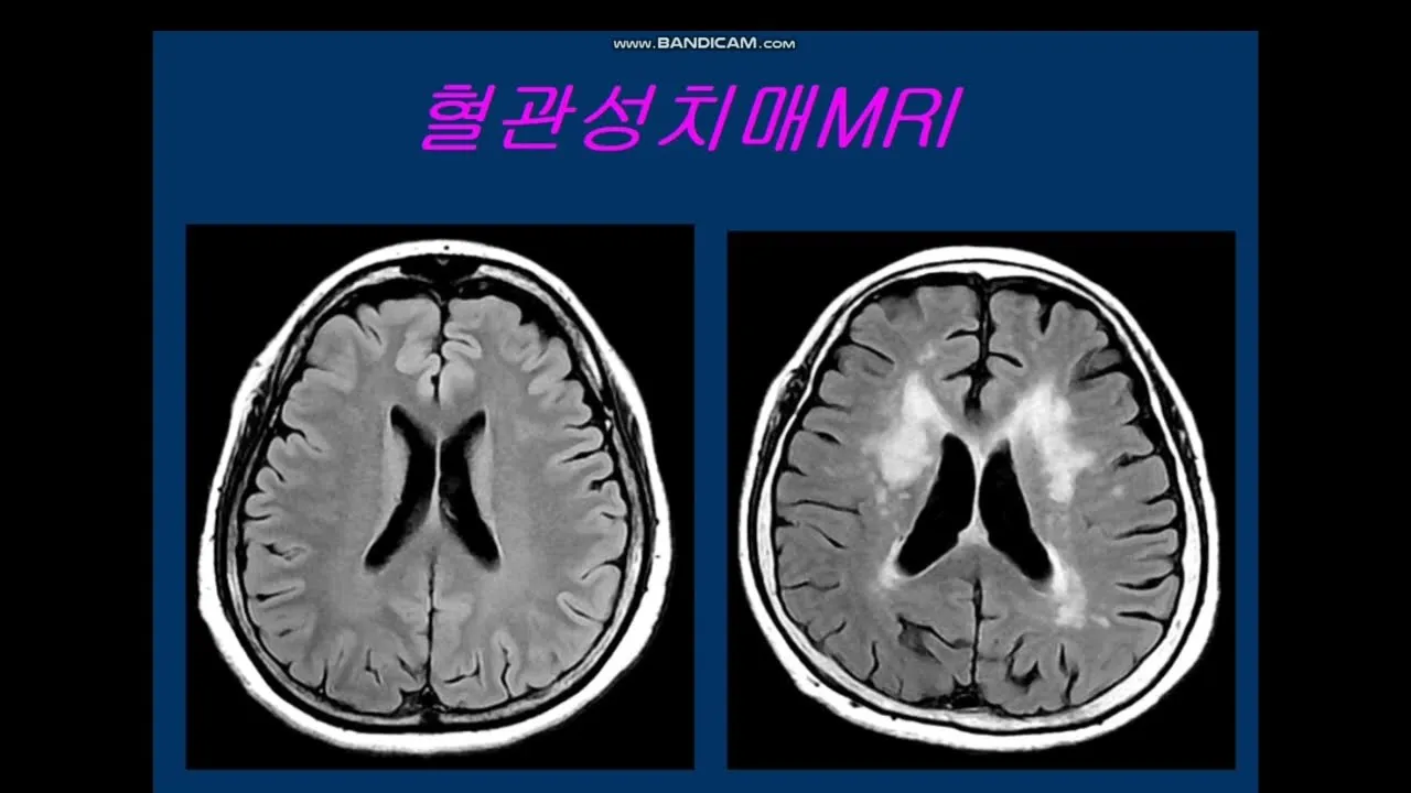 혈관성치매 원인 증상 치료법과 예방 생활습관_9