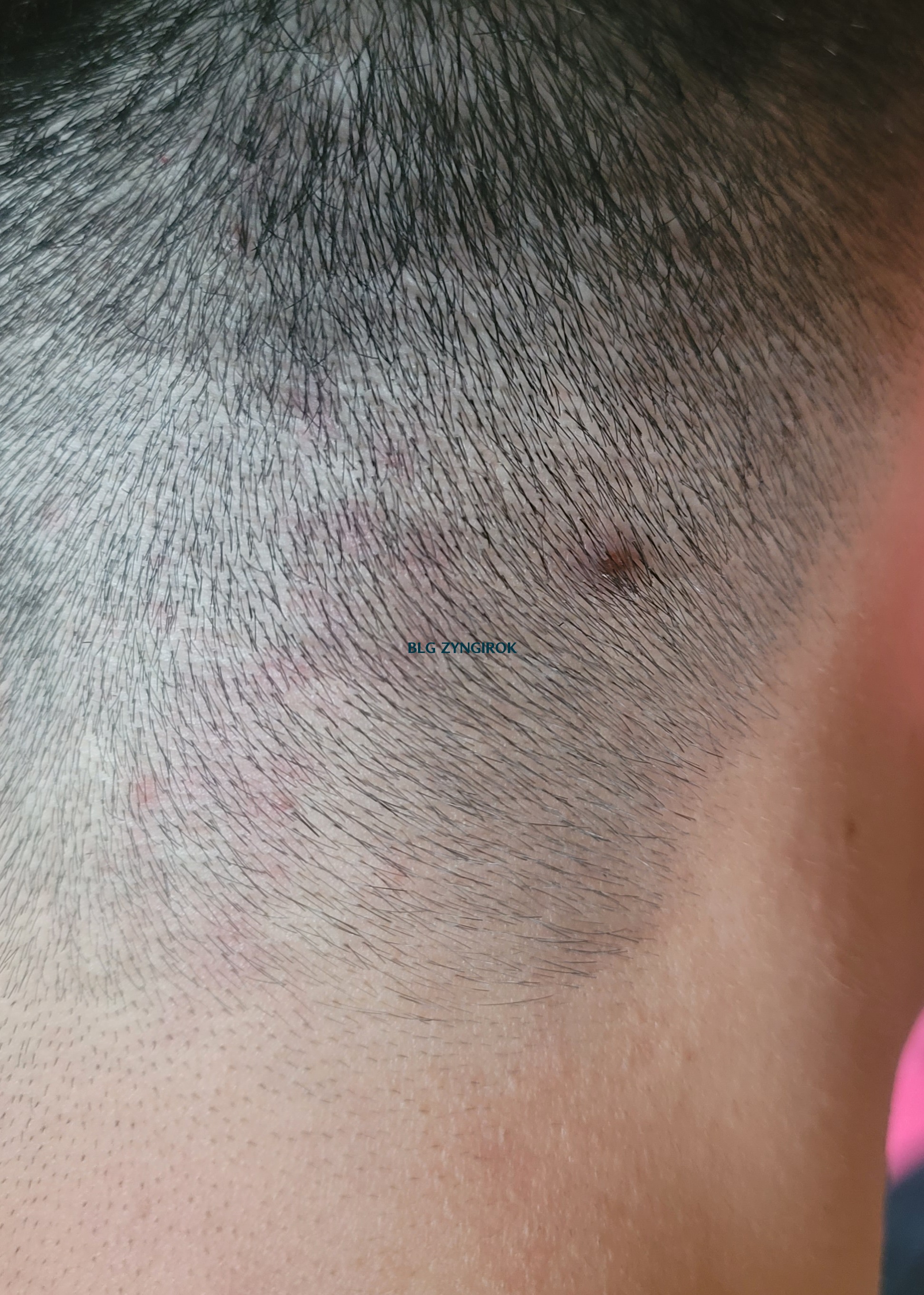 뒷머리 두피모습이다. 큰 모낭염이 하나 도드라져 보인다.