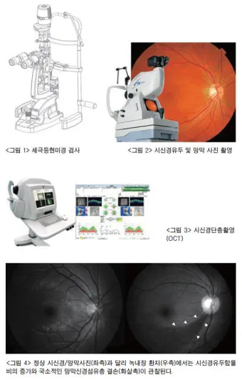 녹내장 진단 검사 비용 안압 검사주기 관리법_14