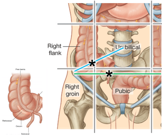 맥버니점 충수 위치