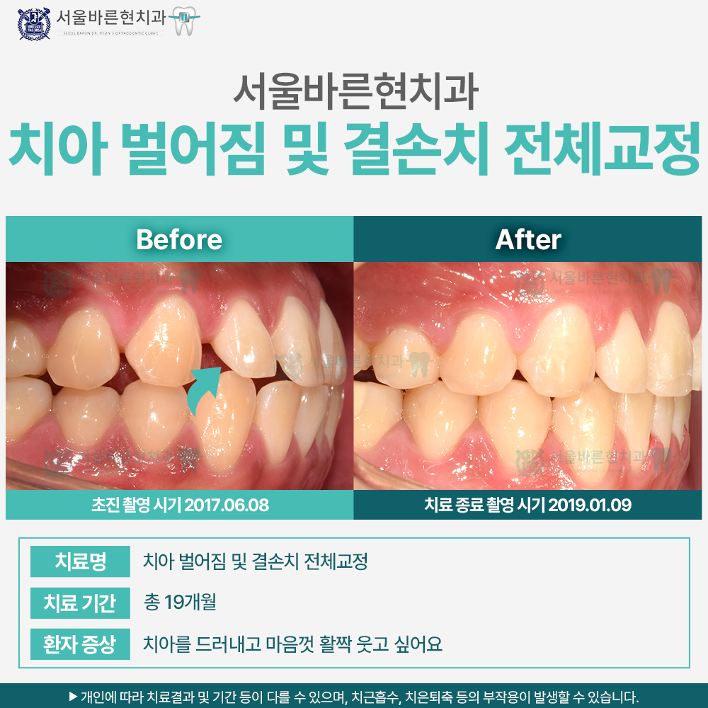 해운대치아교정